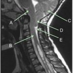 Arnold-Chiari tipo 1