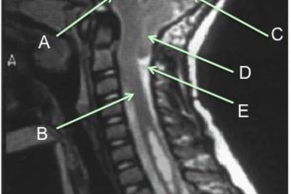 Arnold-Chiari tipo 1