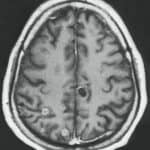 cistos-cerebrais-neurocisticercose-tratamento