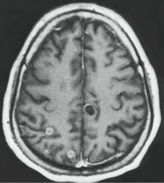 cistos-cerebrais-neurocisticercose-tratamento