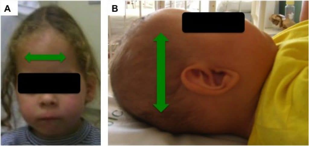 Craniossinostose