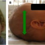 Craniossinostose