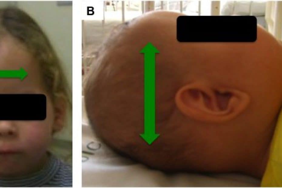 Craniossinostose