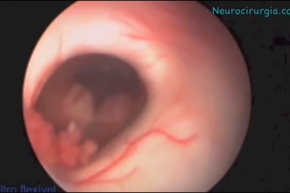 endoscopia_cerebral_-_neuroendoscopia_-_hidrocefalia_-_tratamento_endoscopico_0