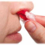 epistaxe-sangramento-nariz