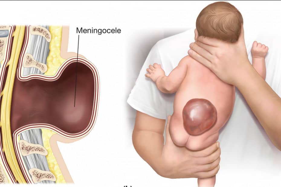 meningocele