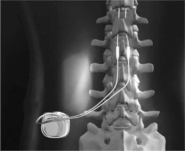 Neuroestimulador