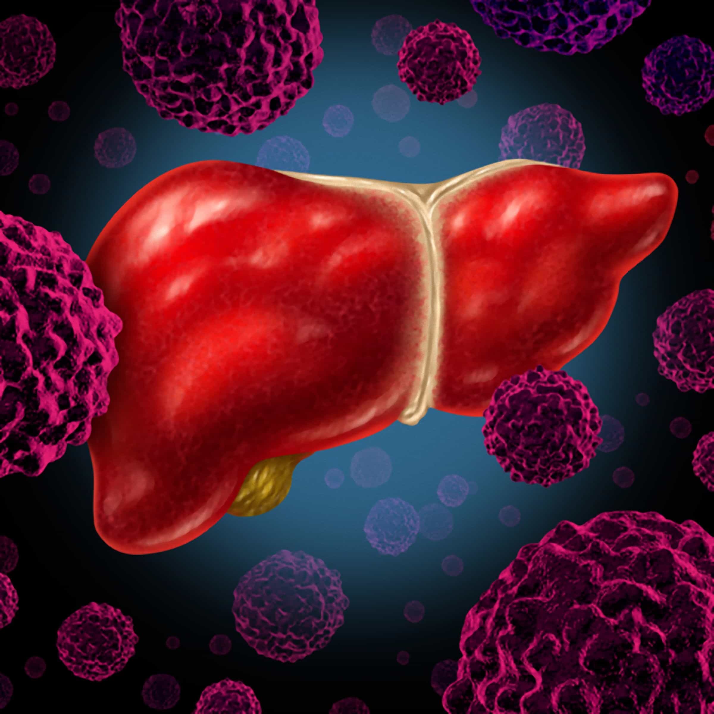 Tratamento para tumor no fígado: orientações para quimioembolização