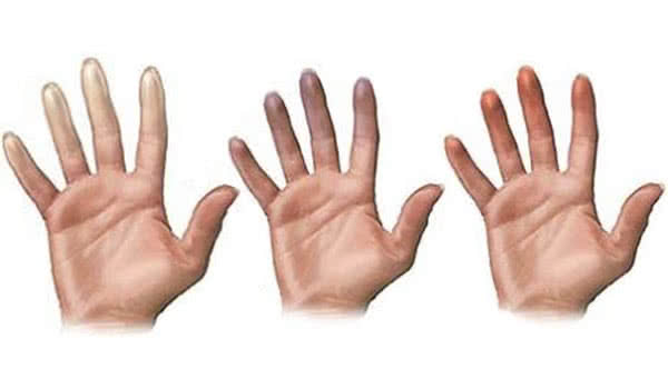 Fenômeno de Raynaud