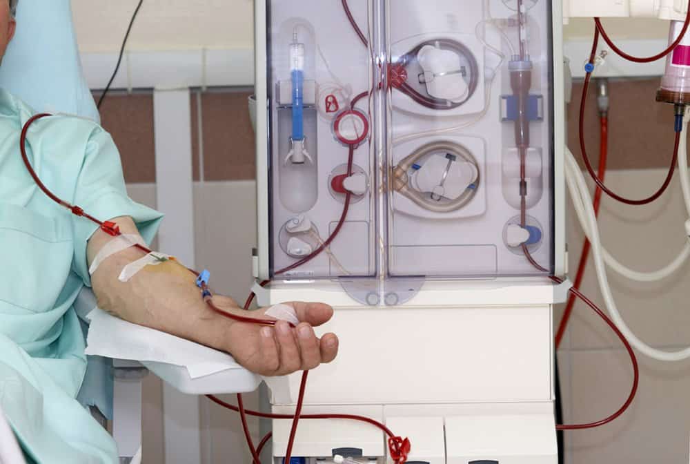 Fístula Arteriovenosa para Hemodiálise (FAV)
