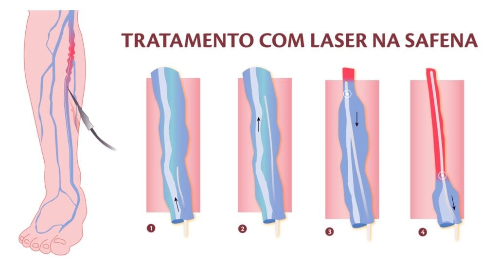 Passos do tratamento de varizes com endolaser na veia safena