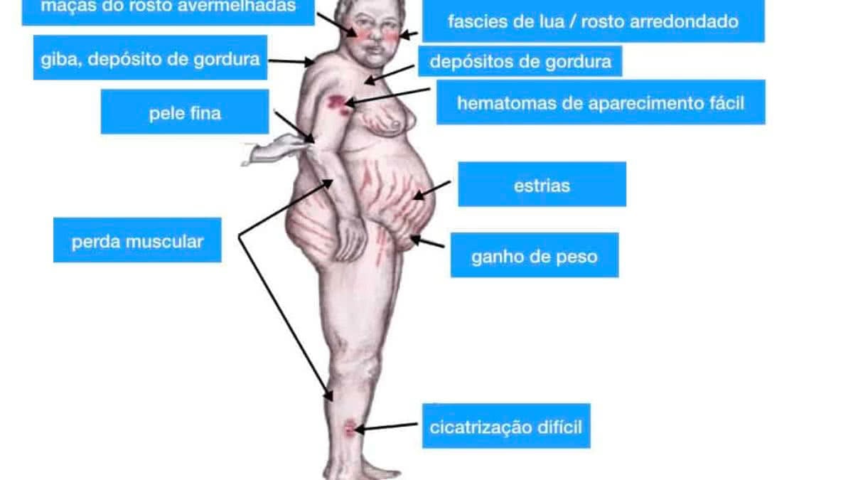 Conheça a Doença de Cushing: sintomas, causas e tratamentos