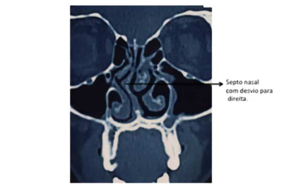 desvio-de-septo-cepto_e