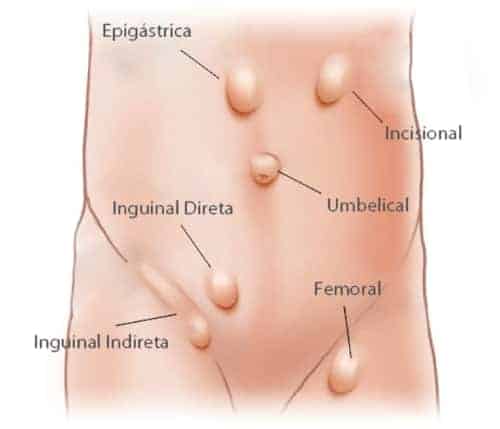 hernia-inguinal_e