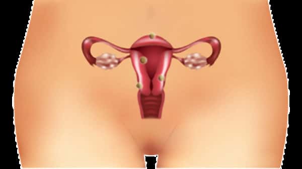 Embolização Uterina para tratamento de miomas