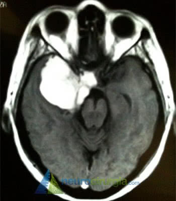 meningeoma-sao-paulo-especialista-consulta-cirurgia-moderna