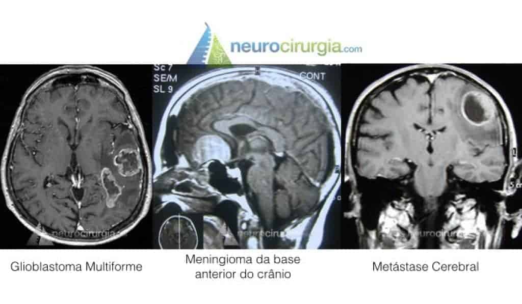 neurocirurgia, neuroendoscopia, cirurgia cerebral, tumor cerebral, neuro, cirurgia neurológica, cirurgia de coluna, em que hospital operar a coluna, melhor centro-cirurgico de sao paulo, com quem operar, cranio, neurocirurgiao,  hérnia de disco, médico de coluna, lombalgia, nervo ciático, dor na coluna, sacroileíte, acupuntura, cirurgia da coluna, tratamento coluna, neurocirurgia, neurocirurgião, cirurgia minimamente invasiva da coluna, infiltrações, bloqueios