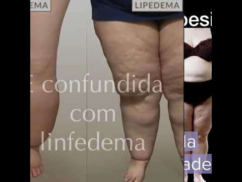 Lipedema: Conheça a condição médica que causa acúmulo de gordura