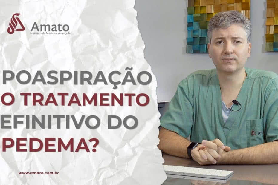 Lipedema: Conheça a condição médica que causa acúmulo de gordura