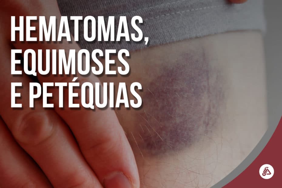 Hematomas, equimoses e petéquias