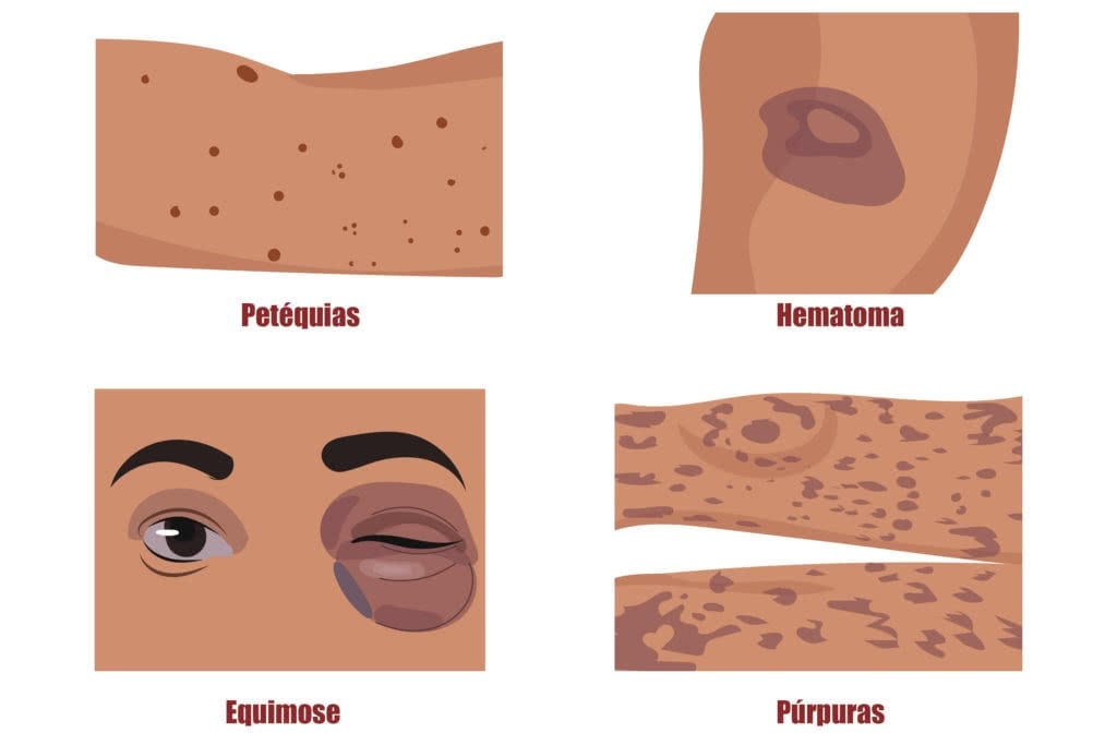 Hematoma, equimose, petequia, púrpura