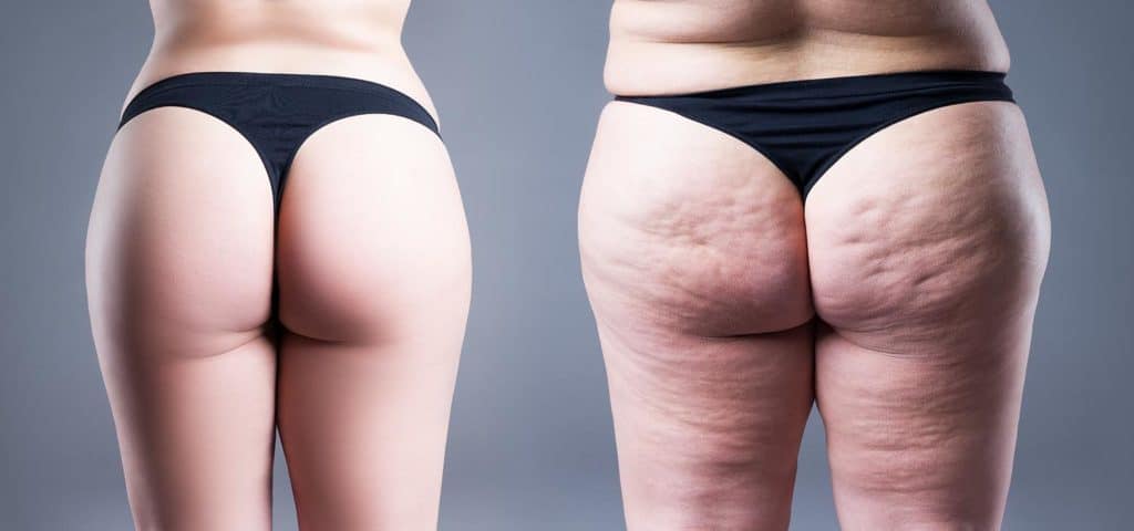 Lipedema