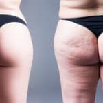 Lipedema