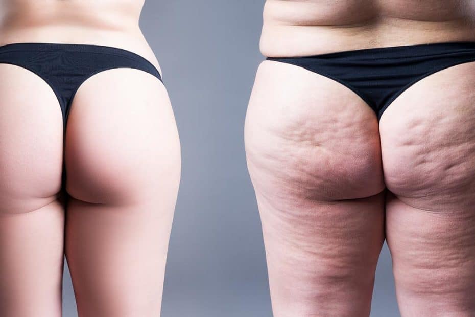 Lipedema y linfedema: ¿cómo diferenciarlos?