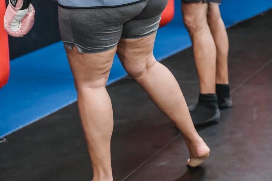 Lipedema: a doença crônica que afeta mais de 10% das mulheres