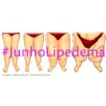 Junho Lipedema