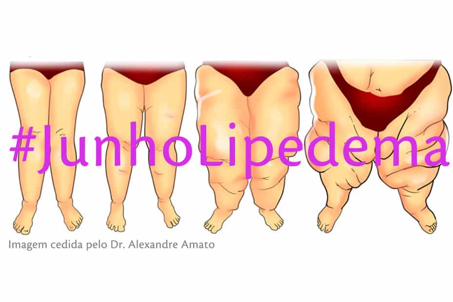 Lipedema: entenda como a doença atinge mulheres