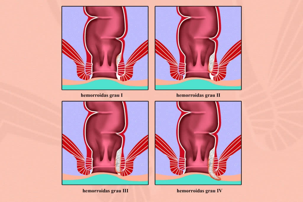 Classificação de hemorroida