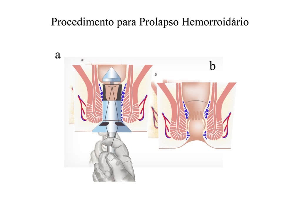 PPH - Procedimento Prolapso Hemorroidario