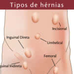 Tipos de hérnias de parede