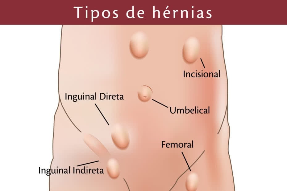 Tipos de hérnias de parede