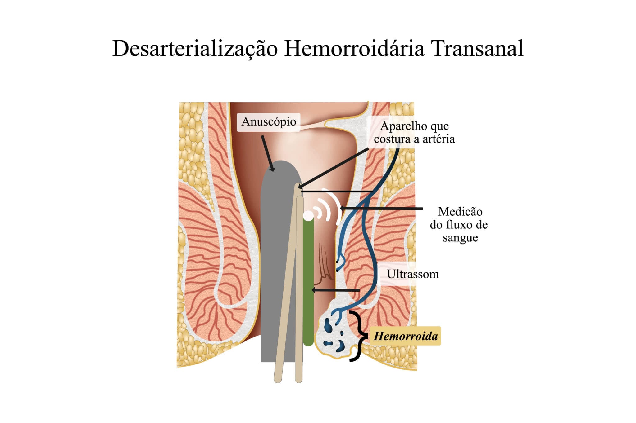 Cirurgia de hemorroida: Conheça a opção mais prática e eficiente