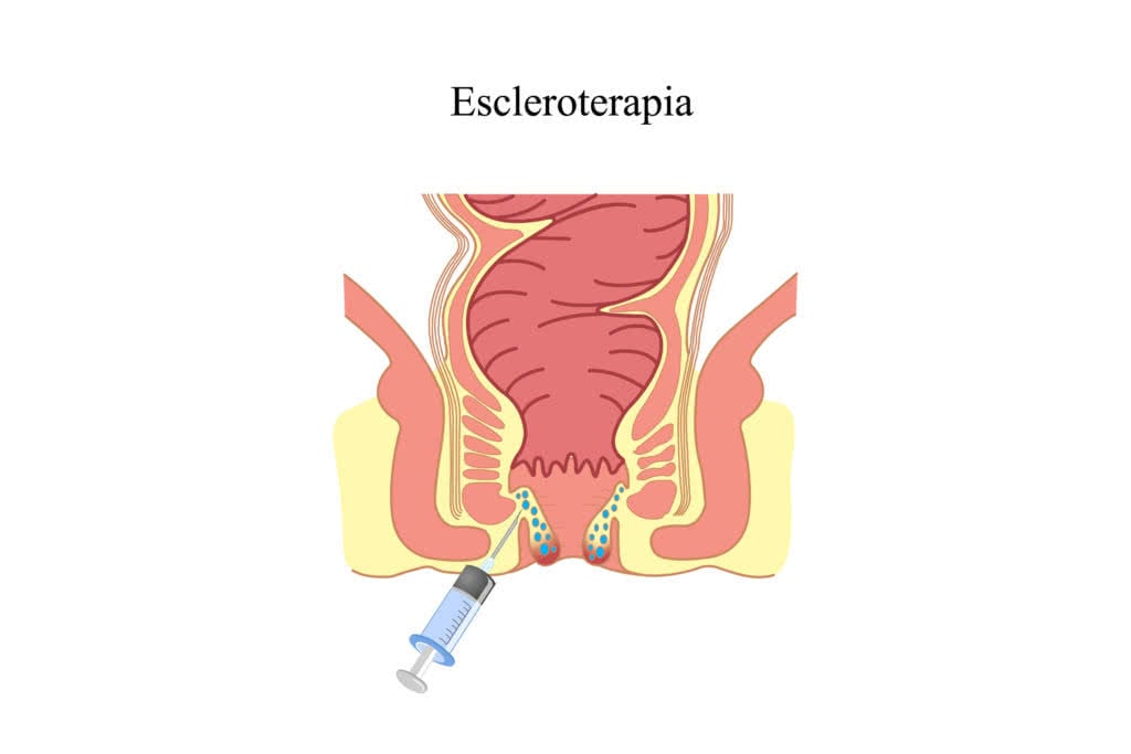 Escleroterapia de hemorroida