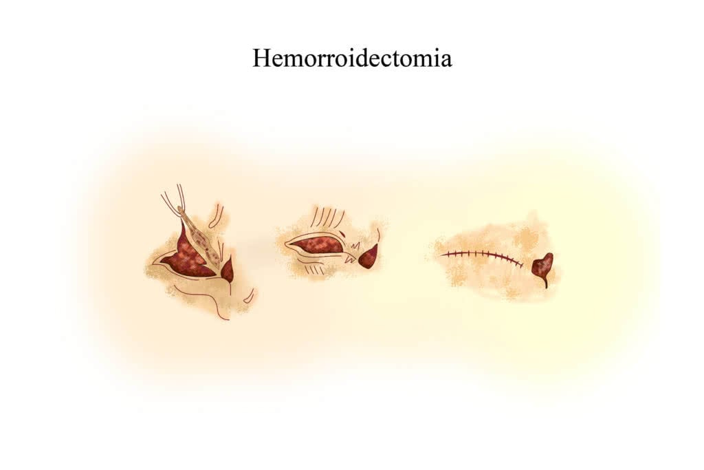 Hemorroidectomia