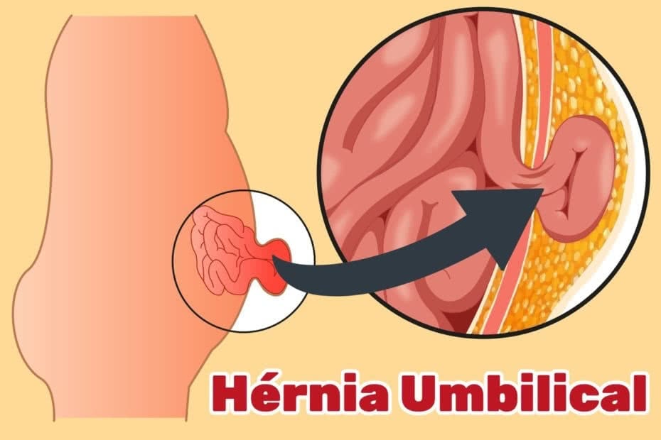 Tenho hérnia. Devo evitar alguma atividade física? – Dr