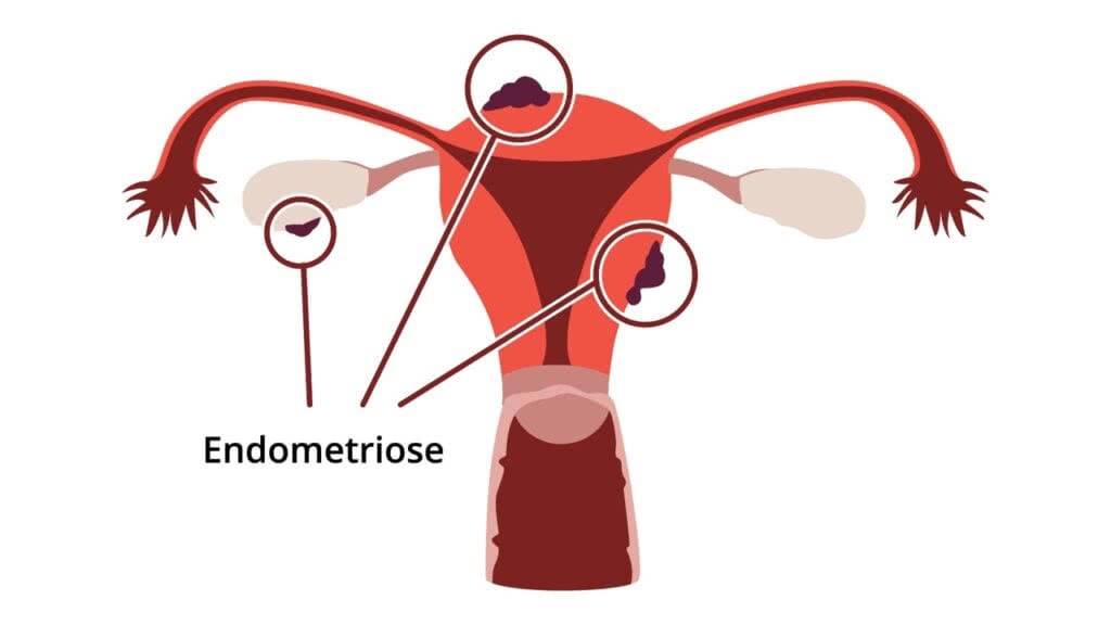 Endometriose  CheckUp da Fertilidade