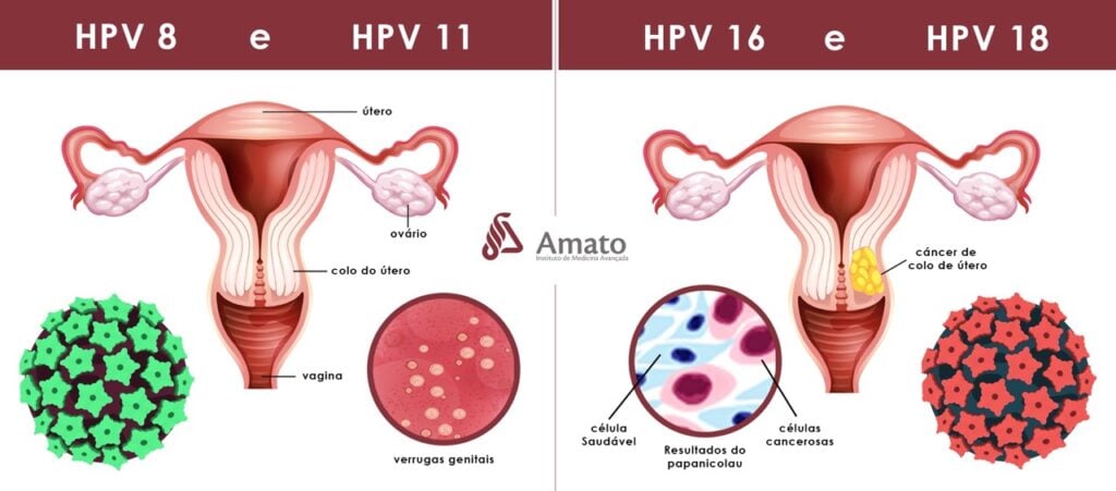 Tipos de HPV