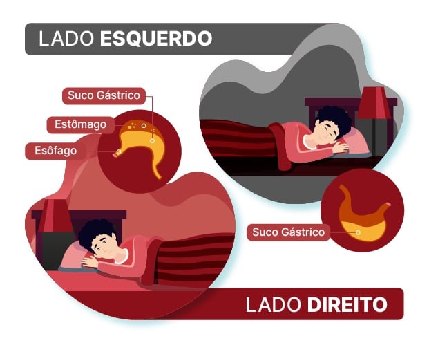 Posição para evitar o refluxo gastroesofágico