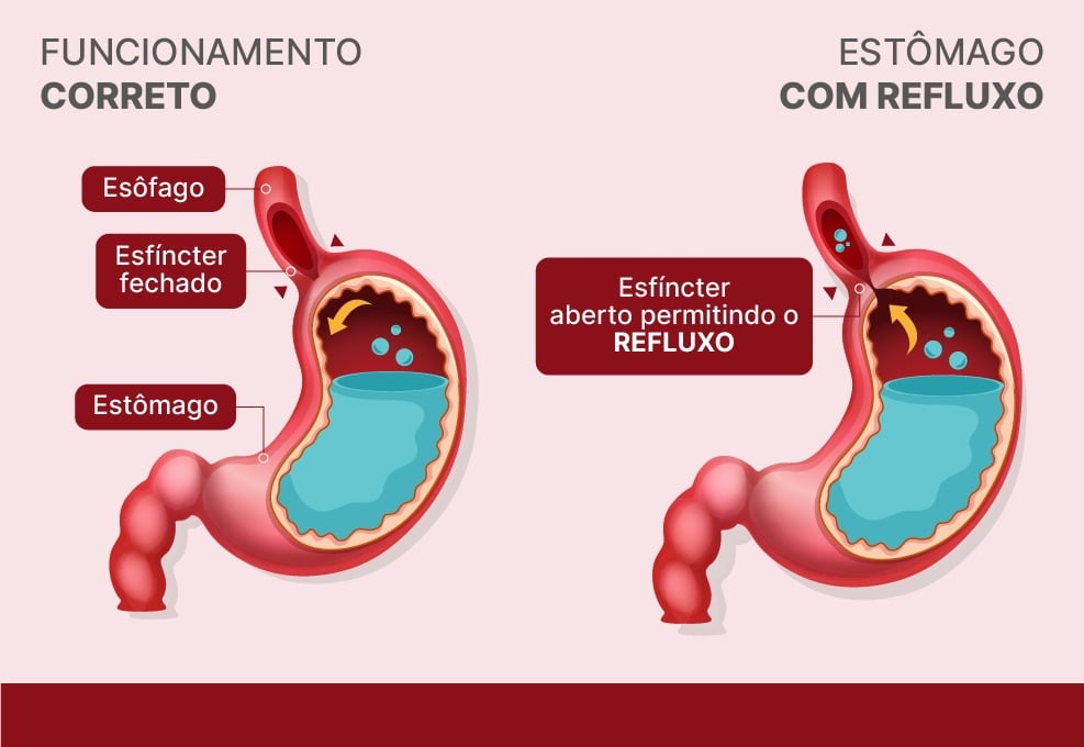 Anatomia do estomago e do refluxo gastroesofágico