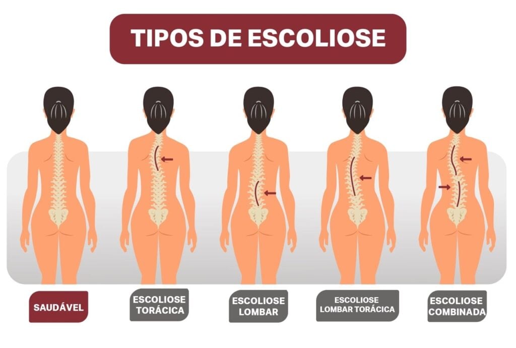 classificação de tipos de escoliose