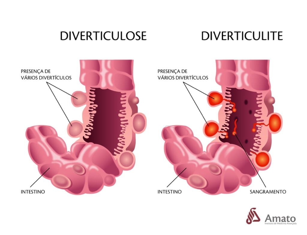 diverticulite vs doença diverticular dos cólons