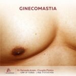ginecomastia